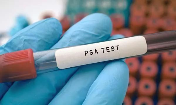 PSA Testing and Prostate Cancer Screening: A Simple Starting Point